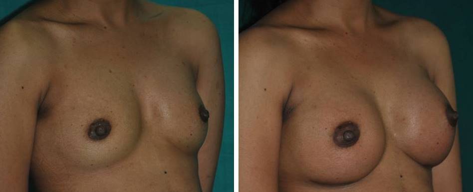 Breast implant surgery result in Cochin